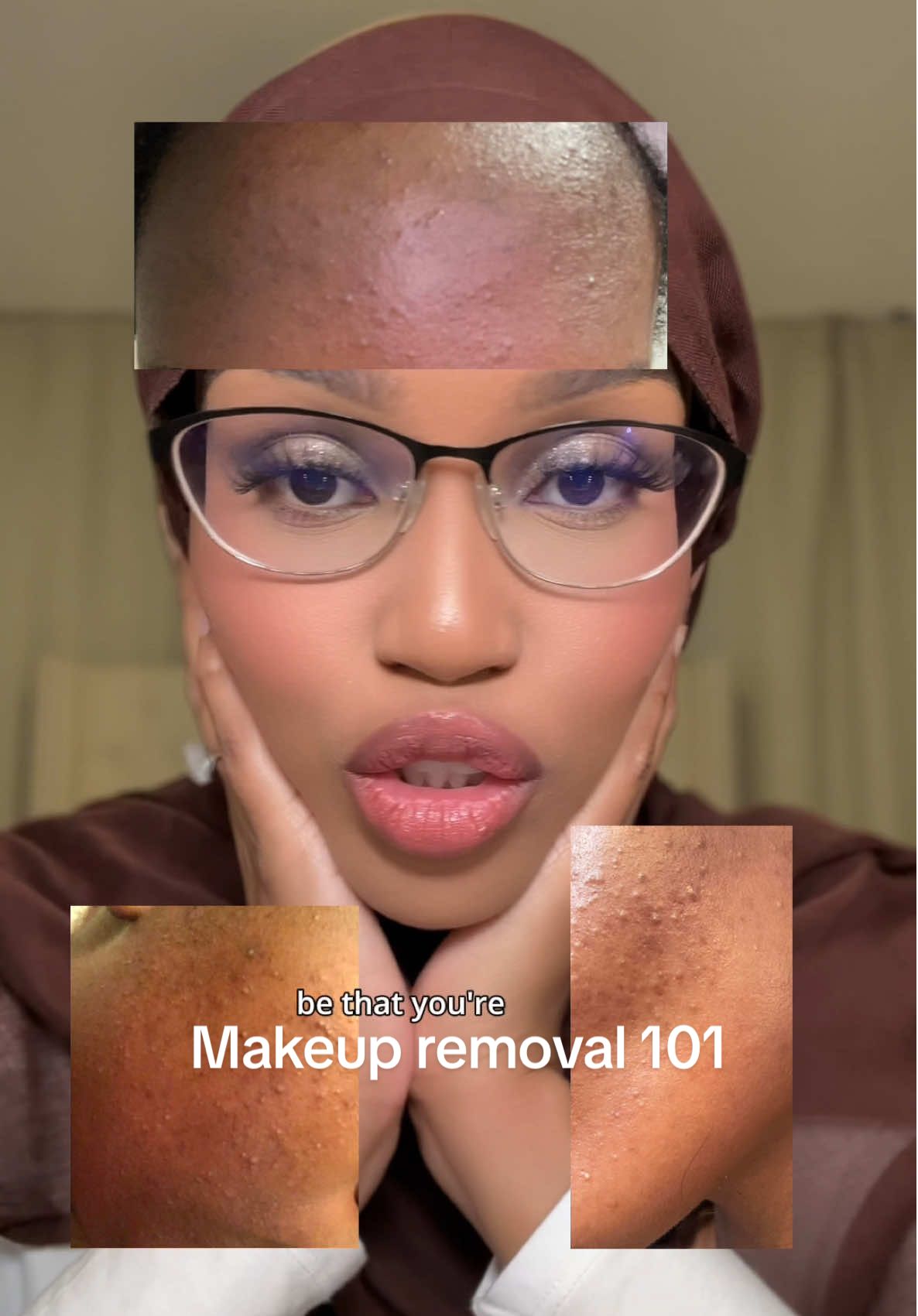 Unclean skin and dirty makeup brushes did my skin so bad! #skintok  @Naturium ginseng cleaning balm @Fresh Beauty Soy Face Cleanser @medicube global toning pads #skincaretips #acneproneskin 