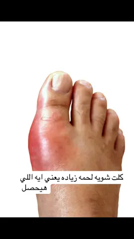 #النقرس_وسنينه