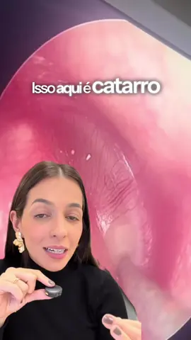 Catarro no ouvido! 😱 Você sabia que essa é uma das principais causas de PERDA AUDITIVA nas crianças? A otite média secretora é caracterizada por acúmulo de líquido dentro do ouvido sem sinais agudos de infecção! Não dói e não dá febre, mas pode causar um grande prejuízo na audição e desenvolvimento do seu filho! Alguns dos principais fatores de RISCO para esta condição: - Crianças entre 1 e 6 anos  - Gripes, resfriados e rinossinusites recorrentes  - Aumento da adenoide - “carne esponjosa” (PRINCIPAL causa de obstrução da tuba do ouvido) - Frequentar creche/escola  - Exposição à fumaça de cigarro  - Alergias respiratórias (como rinite alérgica) - Ausência ou curta duração do aleitamento materno - o leite materno protege contra infecções respiratórias! - Uso de mamadeira em posição deitada Anota aí: quando o assunto é atraso fala e linguagem, a criança sempre deve ser avaliada pelo otorrino quanto à integridade de sua audição! 😉 #otorrino #otorrinolaringologia #otitis #pediatria 