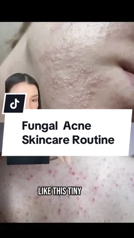 Skincare routine & tips for fungal acne #fungalacne #fungalacnesafe #acneprone #acneproneskincare #fungalacnetips #acneskincareproducts #fungalacnetreatment #skincaretips #greenscreenvideo #greenscreen 