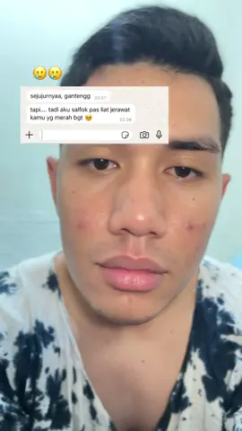 P3k kalo lgi insecure karna jerawat kemerahan :)