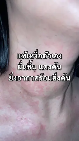 ใคร #แพ้เหงื่อ คัน #เป็นผื่น ปล่อยไว้ระวังผิวพัง  ทาตัวนี้ บำรุงฟื้นฟู ผิวแข็งแรง ไม่แพ้ง่าย ด้วย #ซูตติ้งครีม