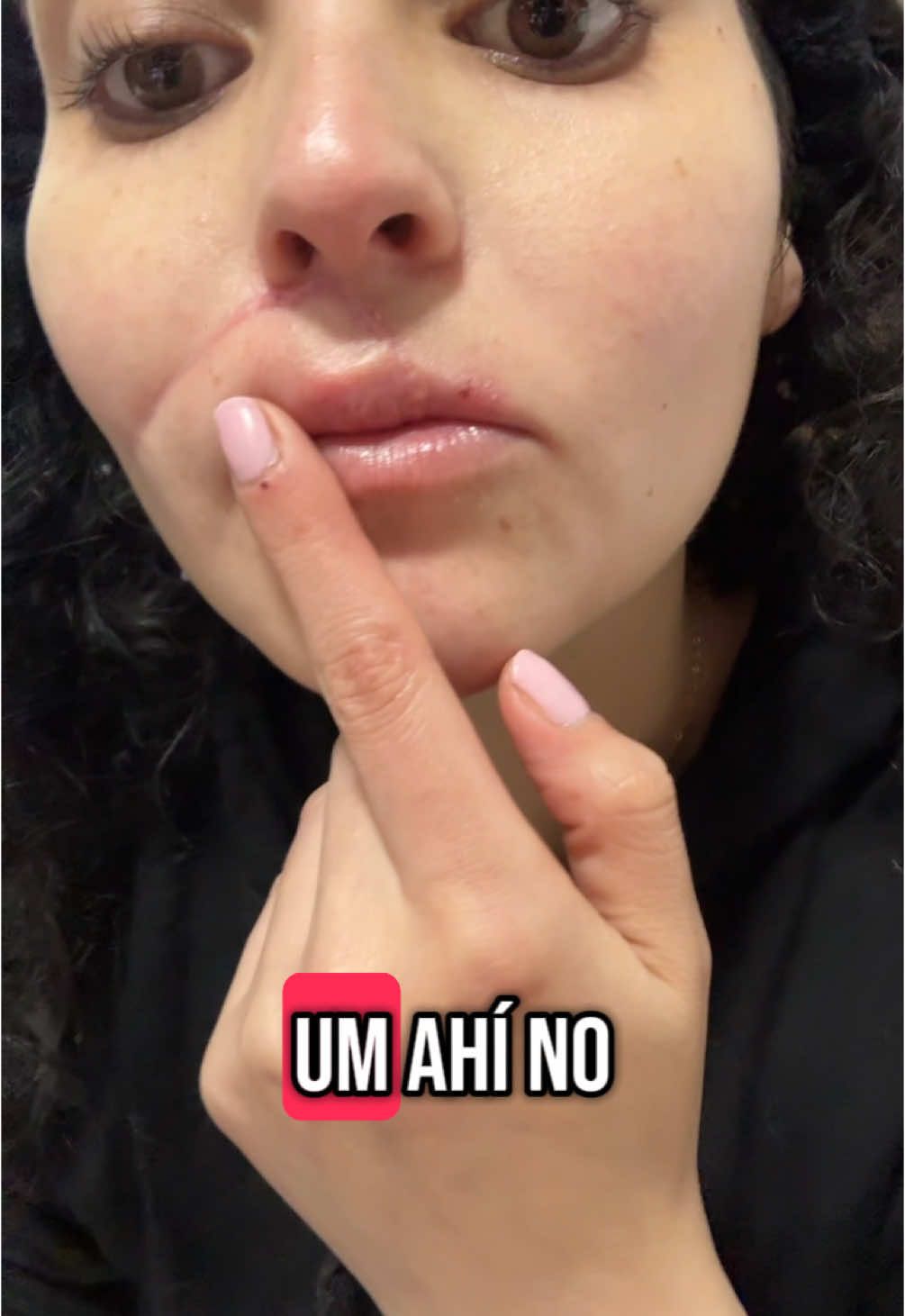 Para las preguntas de cómo cuido la cicatriz,Cicaplast B5 y usen mucho bloqueador solar🥰 #tiktokviral #fyppppppppppppppppppppppp #mujeresqueinspiran #2025 #vibes #accidentetrafico #cicatrices #cicaplastbaumeb5 #cicaplast #accidentedetransito #moto #gsxr150 #fracturadeclavicula 