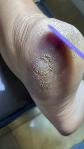Spa dos pés 🦶 Produtos usados são da loja Sie cosmético 1- Creme esfoliante 2- Manteiga Hidratante 🧴 3- Vela de Massagem ❤️🏷️ Use Cupom “CARLA”  #asmr #asmrfoot #asmrsounds #asmrsatisfying @Sie Cosméticos 