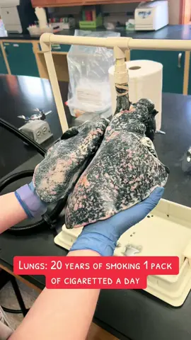 Prolonged exposure to cigarette smoke can lead to serious health issues, including chronic bronchitis, emphysema, and lung cancer. The difference between healthy and smoke-damaged lungs is a stark reminder of the importance of lung health and the benefits of quitting smoking. Hashtags: #LungHealth #StopSmoking #QuitSmoking #SmokingAwareness #CigaretteDamage #HealthyLungs #PublicHealth #MedicalEducation #Pulmonology #HealthAwareness #AntiSmoking #RespiratoryHealth #NoToSmoking #TobaccoFree #MedicalVisuals