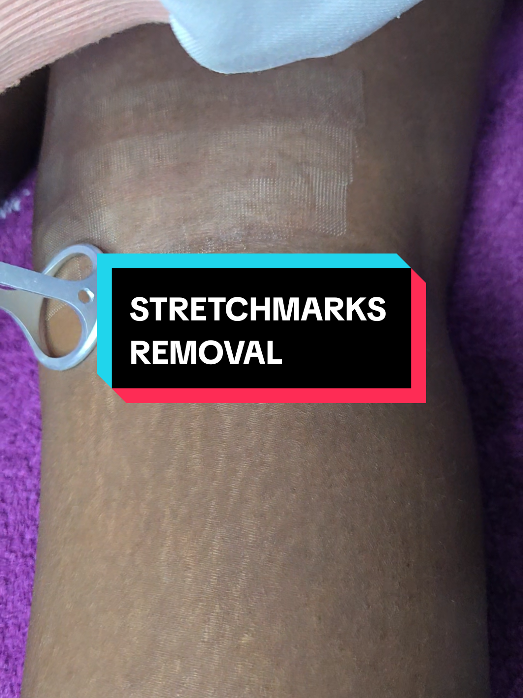 Restore Your Skin’s Smoothness. Our stretch mark removal treatments target texture and discoloration, helping fade marks and improve skin tone—so you can feel confident in your skin again. 📍 Hazina Trade Center, Monrovia Street 📞 Call 0798 362 752 | WhatsApp 0715 456 524 #StretchMarkRemoval #SmoothSkin #SkinConfidence #AestheticClinic #creatorsearchinsights 