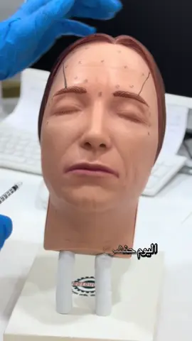 حقن البوتكس لرفع أطراف الحواجب#بوتكس #فيلر #اكسبلورexplore #العين #اكسبلور_فولو #الامارات #جوفيديرم #اكسبلور 