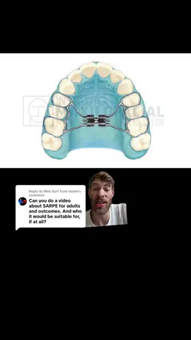 Replying to @Web Surf from Home #greenscreen  60 second summary of expansion - SARPE is surgically assisted rapid palatal expansion (rarely done anymore).  DOME is SARPE cuts with MARPE.  Then you have different surgical techniques and expansion appliances.  With custom marpe, you may not even need cuts! Ask your orthodontist who can then do it themselves or refer you out!