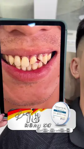 Răng ố vàng - Răng gãy mẽ và sự thay đổi sau 2 ngày 🥰🦷