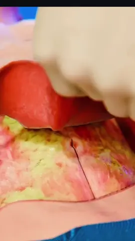 How Excess Skin Removal Surgery Works Part 2