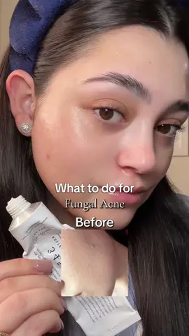 This isn’t regular acne. Thankfully Dr. Althea 345 Relief Cream is fungal-acne safe and helped it disappear. 🤍✨ @dr.althea_official  #fungalacne #dralthea #skincaretip #glowyskin #skintok #barriersupport #acneroutine #glassskin #fyp #jocycs #jocelynsoto 
