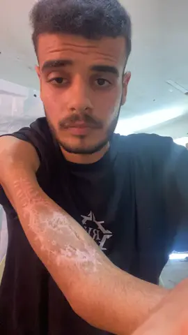 Save Mahmoud and his hand ‏#fyp #fup #viral #foryoupage #govirall #fypsy #fypg #fyyyp #frp #kids #business #fyyy #f #fyp #foryou ##foryoupage #fypppppppppppppppppppppppppppppppppp #viral #water #Home #food #job #usa #indonesia #dubai🇦🇪 #unfrezzmyaccount #support_me #dubaichocolate #foryou #fypシ #foryoupage #viralvideo #trend #explore #Love #support #helpme #life #family #saveus #tiktok_arab #palestine #rebuild #hope #future #dubai #usa #indonesia #tiktok #tiktokviral #fypdaily #momlife #baby #reallife #savelives #war #refugees #recovery #motherhood #voice #gaza #prayforus #helpnow #emergency #humanity #peace #rebuildhope
