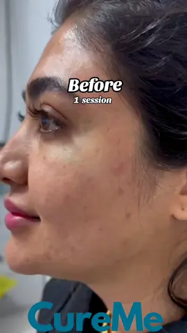 Acne scars tell a chapter, not the whole story. Let us help you turn the page. Experience gentle yet powerful correction designed to soften scars and restore skin's natural harmony. Reclaim your skin. Reclaim your glow. #AcneScarHope #SkinLove #ScarFading #BeYourConfidentSelf #SkinPositivity #AcneScarSupport #SkinRejuvenation #EmbraceYourSkin #SkinHealing #ConfidentSkin #curememedical #cureme #cmc #curememedicalcomplex 