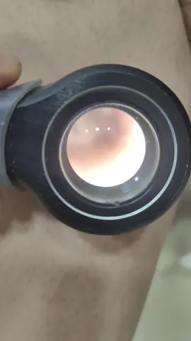 بدون الدرموسكوب ربما لن نستطيع تشخيص الكثير من الاورام  الفيديو لورم حميد لا يحتاجالازالة  #dermatology #dermoscopy #naevus #dermatofibroma 