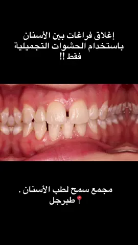إغلاق الفراغات بين الأسنان بحشوات تجميلية فقط .  مجمع سمح المتخصص لطب الأسنان . 📍طبرجل . للحجز والاستفسار : 0537311990  @جمعية سمح للخدمات الطبية #طبرجل #طب_اسنان 