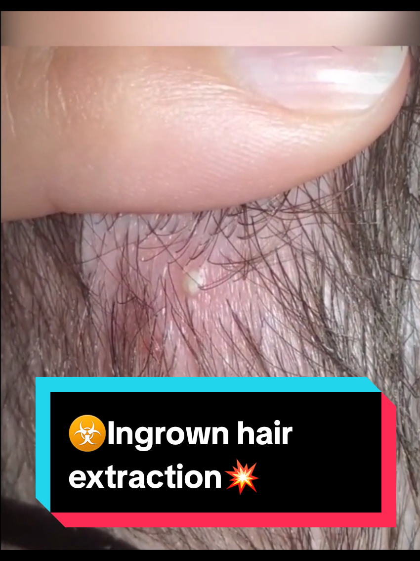#creatorsearchinsights #satisfyingvideo #Ingrownhair #ingrown #ingrowns 