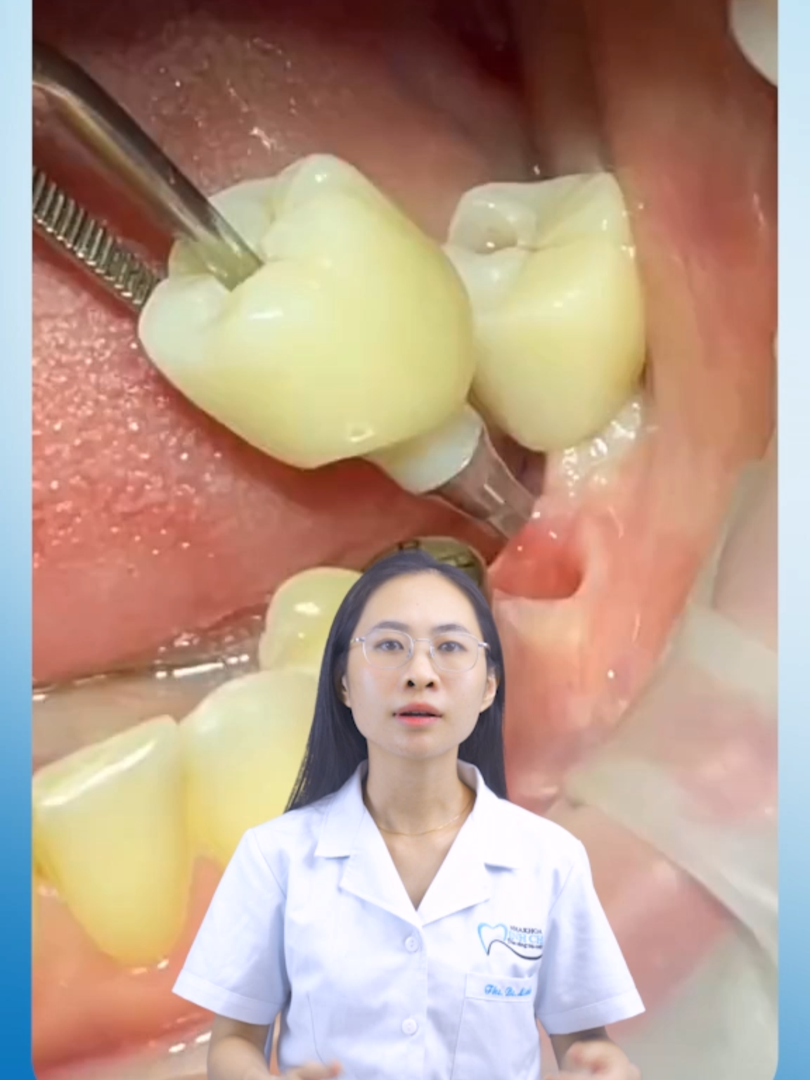 Cận cảnh lắp răng sứ trên Implant #nhakhoaminhchau #xuhuong #nhakhoa #implant #trongrangimplant
