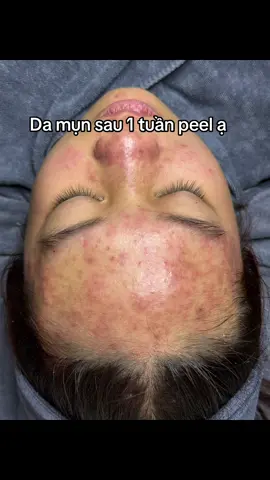 Da mụn mụn sau 1 tuần peel ạ #peelda #spa #xuhuong 