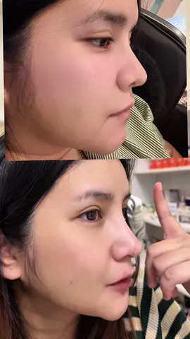 จมูกไร้ซิลิโคน @เสริมจมูก by DSC Clinic @หมอทราย พญ.สุภัทรา หมอหูคอจมูก #แก้จมูก #จมูกโอเพ่น #หมอทรายdscclinic #dscclinic #dscclinicbydrsine 