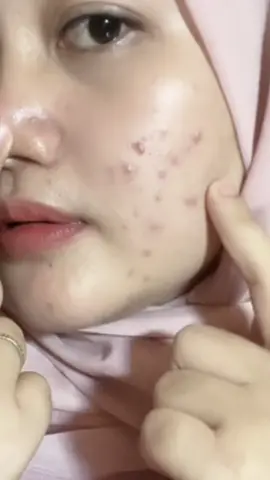 Best affordable acne lotions /obat totol murah  😍🫶🏻🍃#obattotoljerawatg2g #obattotolviral 