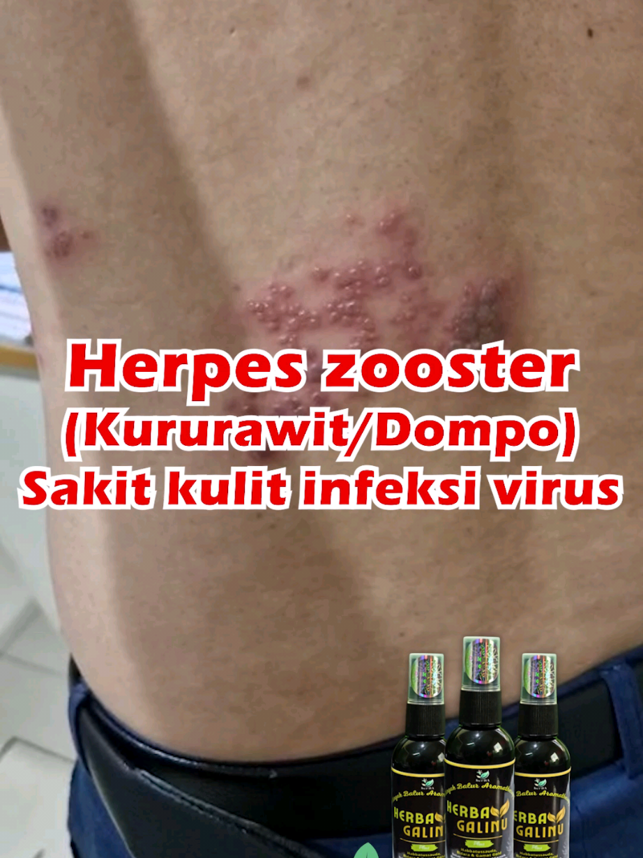 #herbabudinatura #herpeszooster #kururawit #dompo #galinu #minyakbalurgalinu #dranton #antonbudiasih 