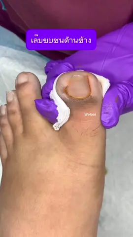 เล็บขบตอเล็บด้านใน#ingrowntoenail #wefootตัดเล็บขบรักษาเล็บเชื้อรา #ตัดเล็บขบมียาชา #เล็บขบ #ตัดเล็บขบ #เล็บขบหนักมาก #เล็บขบอักเสบ 