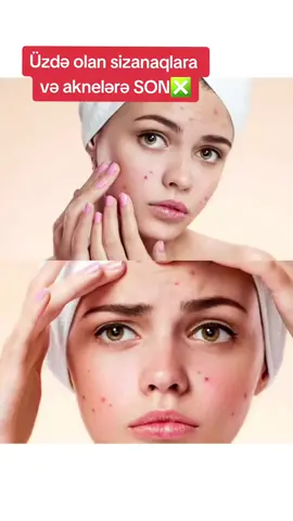 100% NƏTİCƏ 👍 SİFARİŞ QƏBUL OLUNUR. ÇATDIRILMA PULSUZDUR. Öz şəxsi endirim kodunuzu əldə edərək məhsulları anbar qiymətinə əldə etmək istəyirsinizsə mesaj bölməsinə yazın. #faberlic #akne #sizanaqlarucun #deriyequlluq 