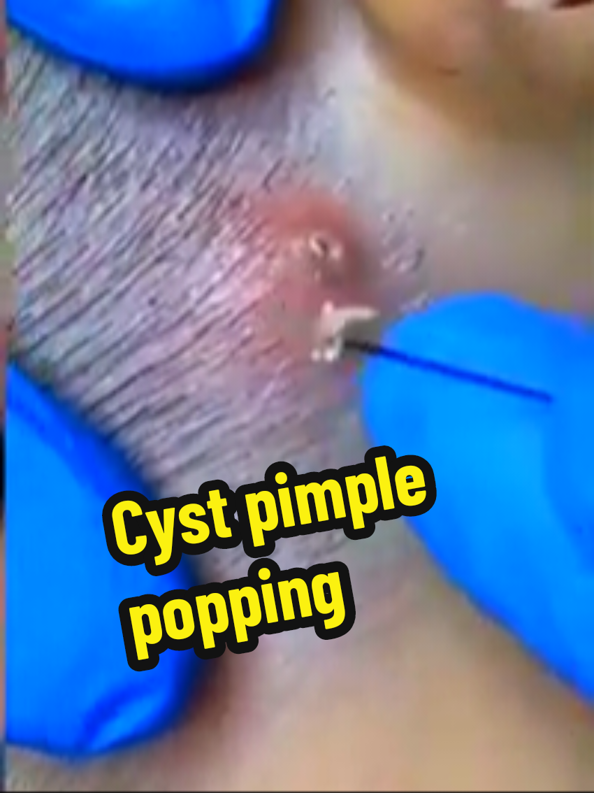 #creatorsearchinsights #satisfyingvideo #pimplepop #pimplepopper 