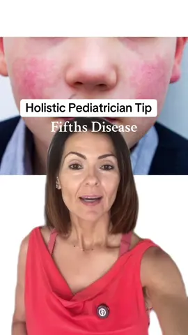 Fifths Disease #pediatriciantips #holisticpediatrician #holistichealthtips #pediatricadvice #holistichealth #viruses 