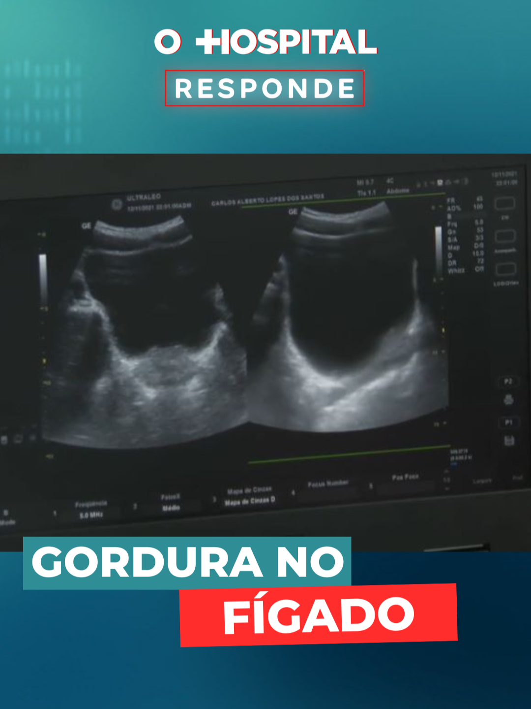 #OHospitalResponde | Você sabe o que é gordura no fígado e como prevenir essa condição? O acúmulo excessivo de gordura nas células do fígado, conhecido como esteatose hepática, pode parecer inofensivo, mas pode evoluir para doenças graves como o câncer. O Dr. Amir Charruf, cirurgião do aparelho digestivo do Hospital Moriah, explica os riscos, sintomas e como evitar o problema. ➡️ Acesse YouTube.com/DomingoEspetacular e assista ao conteúdo completo! #DomingoEspetacular #RECORD