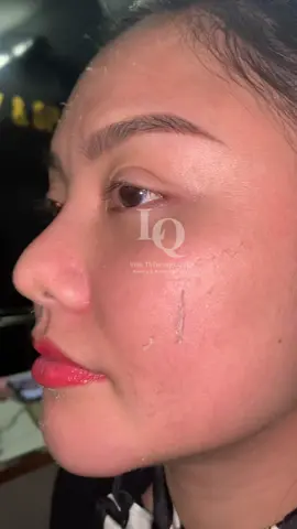 Peel tại nhà #chamsocdaseo#chamsocda#chamsocdamun#chamsocdaseo#chamsocdanam#tanbinh#govap #Lequynh#Lqspa#hocnghespa  #chamsocda #lequynhspa #vienthammylqspa #nanmunbangtay #nanmunbangtambong #nanmunbangcay