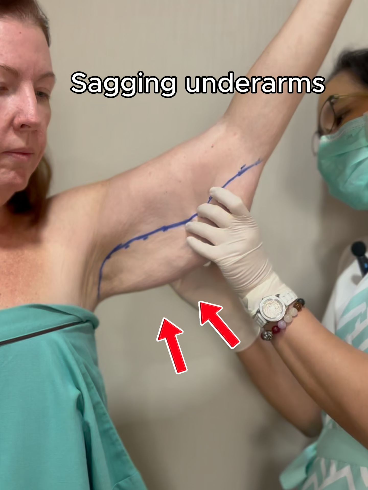 Can you believe this transformation? 🤩 Her arms are now slimmer, more defined, and absolutely stunning! Let us know what you think of her transformation in the comments 🙏❤️ Disclaimer: Results may vary. Please consult with a licensed medical professional. All procedures carry risks. #armlift #plasticsurgery #beforeandafter #transformation #destinationbeauty #plasticsurgeon #thailand