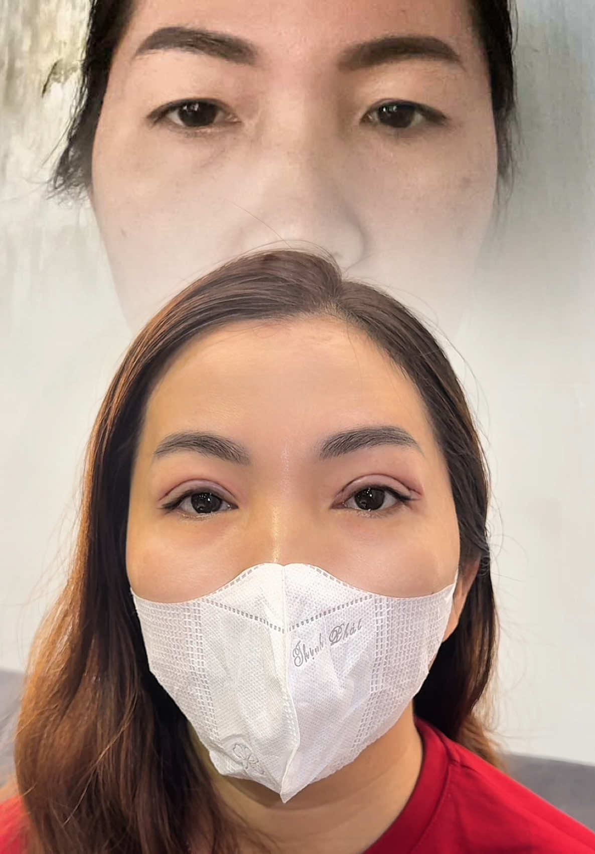 CẮT FULL SIÊU SỤP vừa thực hiện xong ạ. Tham gia nhóm chia sẻ kn phẫu thuật thẩm mỹ để nâng cao tay nghề nhen 