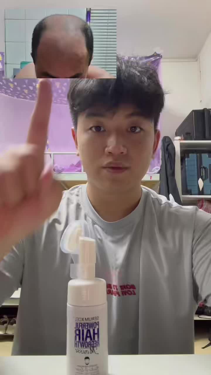 SERUMXCEL Minoxidil for Men and Women，Hair Growth Mousse Hair Care Mousse Haircare Hairline 