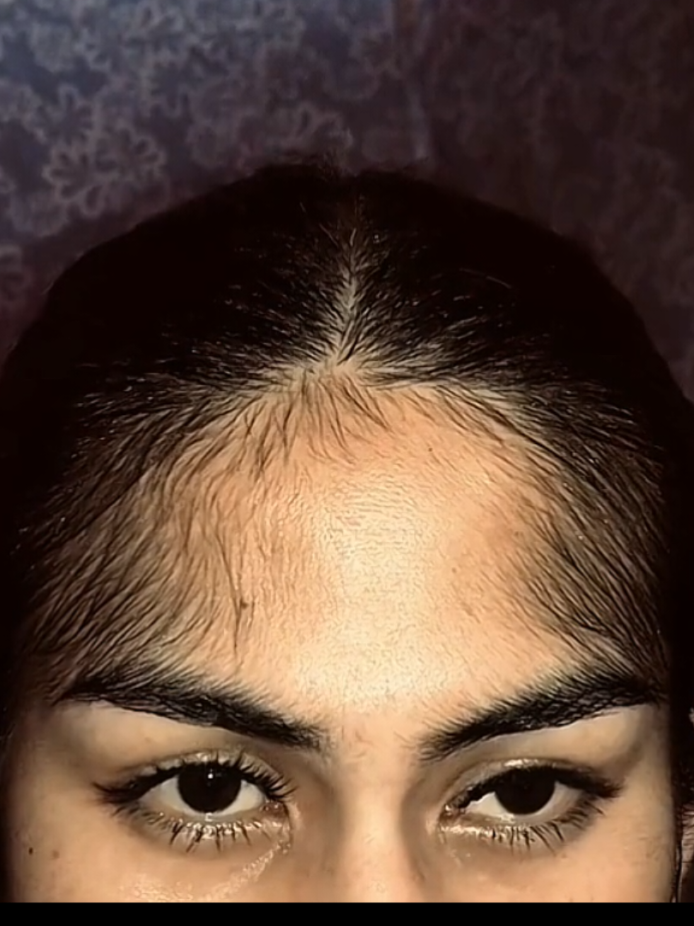 MINOXIDIL 15% effective na pangpatubo ng mga baby hair at para sa mataas ang hairline, hairloss pwede ren sa kilay bigote balbas patilya #minoxidil #hairgrowth #hairgrower #babyhair 