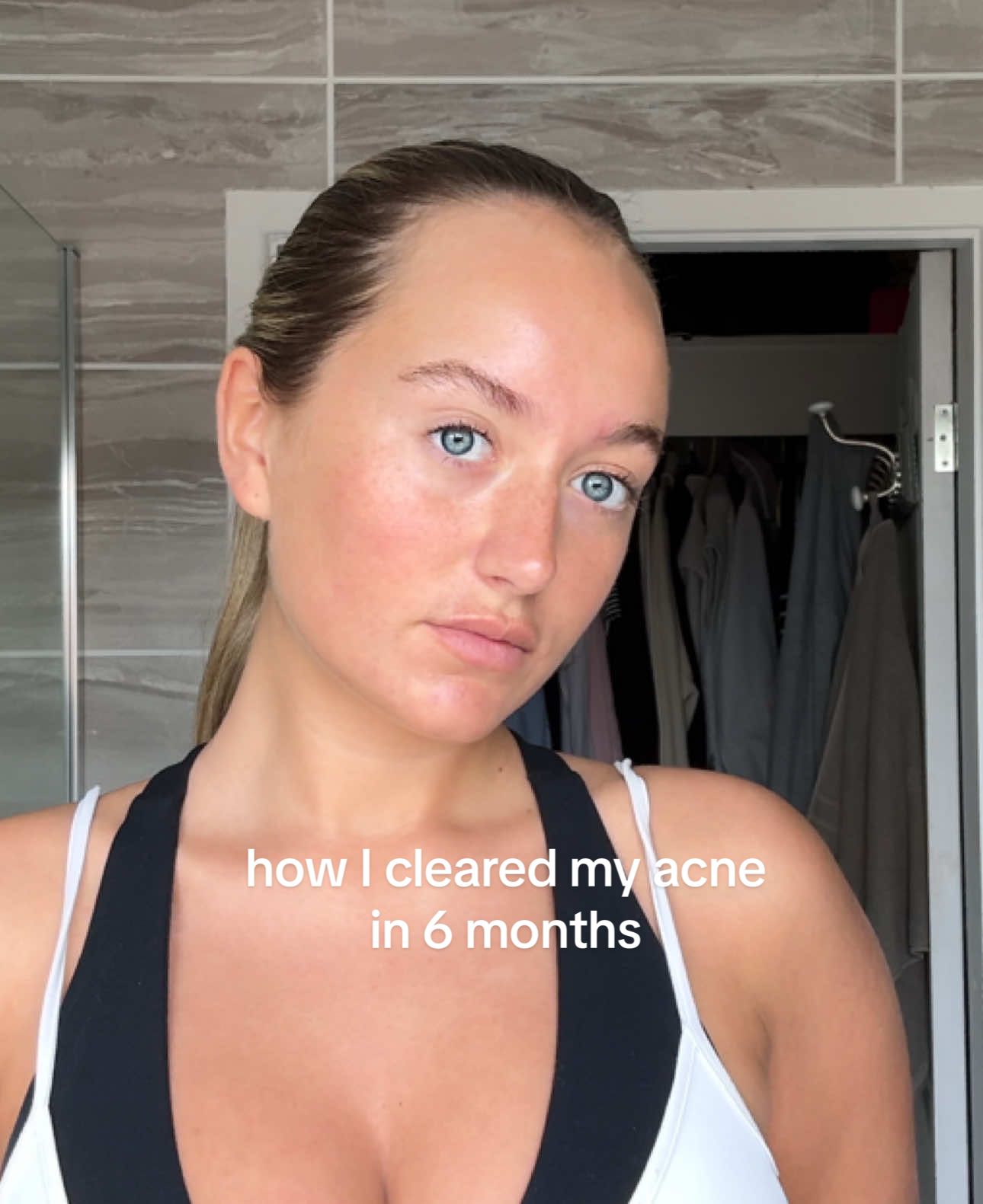 the 4 products that completely cleared my acne in 6 months🪽 after my stories yesterday I thought I’d take you through each product & how I used them 🥹🤍 @Simple Skincare @SimpleSkincareUK @Cetaphil  #acne #acneproneskincare #acnefreeskin #acnejourney #clearskin #clearingmyskin #skincareroutine #skintreatment #skincare #skingoals 