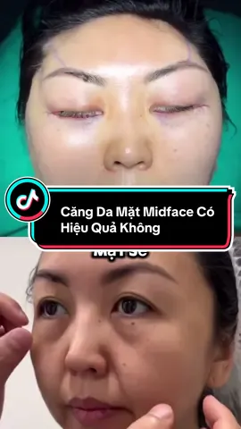 Căng Da Mặt Midface Có Hiệu Quả Không #xuhuong #trending #drlongck1pttm #căng_da_mặt #cangdamat #smasfacelift 