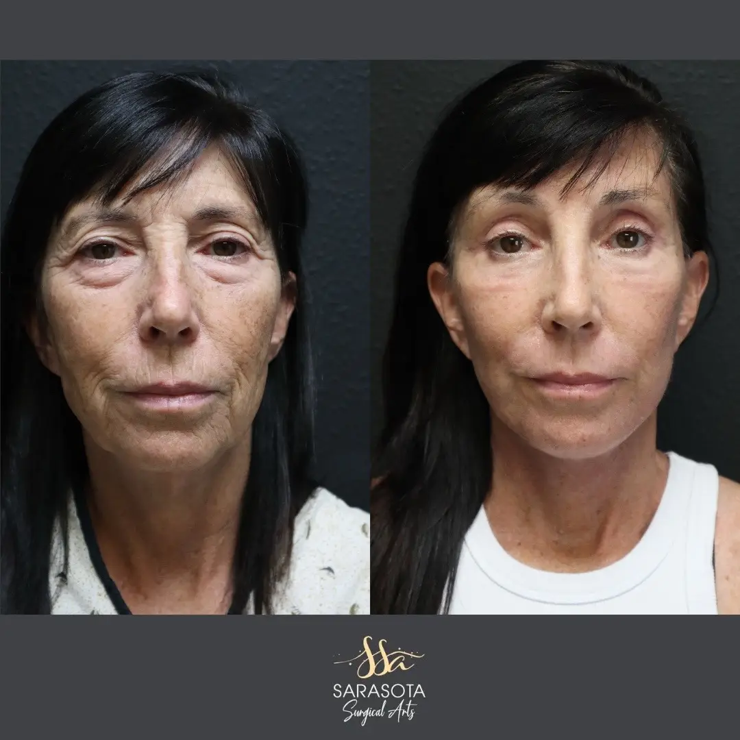Book your consult now! Call us at 941-923-1736 or dm us #facelift #eyesurgery #cosmeticsurgery #plasticsurgeon #cosmeticsurgery #sarasota 