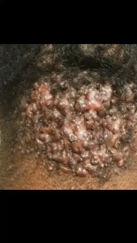 #bumptreatment, #ingrown, #ingrownhair, #acne, #acnetreatment, #acneproblems, #acnetips, #acneskincare, #barber, #londonbarber, #haircut, #london, #localbarber, #hairvideos, #satisfyingvideos, #viral, #explorepage, #barberworld, #ukbarber, #skincare, #haircare, #SmallBusiness, #keloids