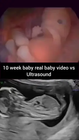 جنين ١٠ آسابيع بين الحقيقة. السونار 10 week baby movement أ.د. محمد مخيمر استشاري امراض النساء والتوليد والعقم و الحقن المجهري ماجيستير و دكتوراة امراض النساء والتوليد - القصر العيني عضو هيئة التدريس بكلية الطب- جامعة القاهرة متخصص في تاخر الحمل و الحقن المجهري - مناظير امراض النساء والتوليد - متابعة الحمل الحرج و الحمل عالي الخطورة - تشخيص و علاج حالات الإجهاض المتكرر للحجز والاستفسار : العنوان : ٣٠٠ شارع الهرم محطة الطالبية مدخل 2 الدور الخامس عمارة معمل ألفا 📞01141511505 📞01011007554 30 شارع مراد من ميدان الجيزة بجوار شركة فودافون الدور الثاني عيادة 107 📞01011755904 📞01552789041 #الحقن #المجهري #الإجهاض #تحاليل #منظار #رحم #رحمي #الهرمونات #خلل #الكروموسوم #نجاح #نسبة #حمل #ولادة #الامومه #حلم  #مخزون #المبيض #اختبار #الحمل #القصر_العيني #محمد_مخيمر  #مخيمر  #استشاري_النساء_والتوليد_والحقن_المجهري #امراض #النساء 