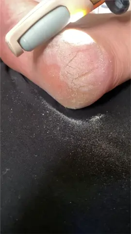 أفضل جهاز للتخلص من الجلد الميت وتشققات القدمين فعال وسهل الاستخدام  للطلب تواصل معنا على الخاص او املء الاستمارة بالأسفل  #العناية_بالجسم  #العناية_بالقدمين  #عناية_بالجسم  #عناية_بالبشرة #العناية_الذاتية  #روتين_جمال 