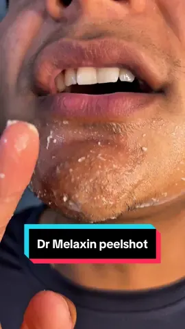 I cleared my pores out 