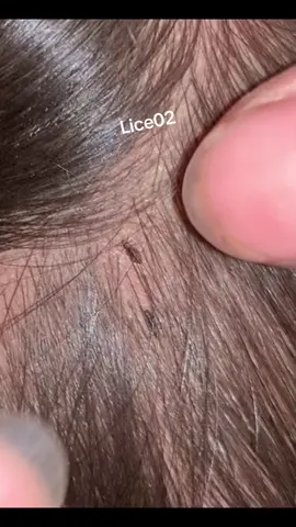 Lice😱😱#omg #lice #liceremoval 