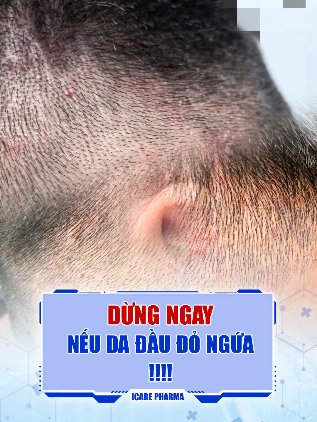 Dừng lại ngay video này nếu bạn đang thấy da đầu xuất hiện những mảng đỏ trắng bất thường #Samdealchienhe #Antisol #Daugoitrigau #Xuhuong #icarepharma #daugoithaoduoc #daugoitrinam #namdadau #khuyenmai #canhbao #xuhuong2024 #Gau #Salecuoithang