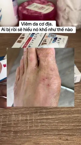 Viêm da cơ địa hay các bệnh về da liễu rất khuyên mọi người nên dùng chai này. Tôi đã dùng và rất hiệu quả nên giới thiệu mọi người dùng thử #viemdacodia #thuoctriviemda #thuocnhatban #benhveda #viemda 