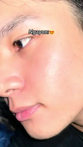 Try it! #skinever #tonerpad#acneproneskin #salicylicacid#exfoliate#glasski n#koreanskincare 