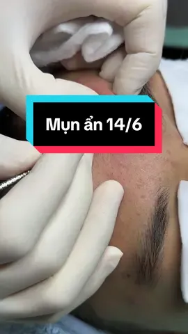 Mụn ẩn 14/6#winspavungtau #trimunvungtau #nanmunvungtau #nanmun 