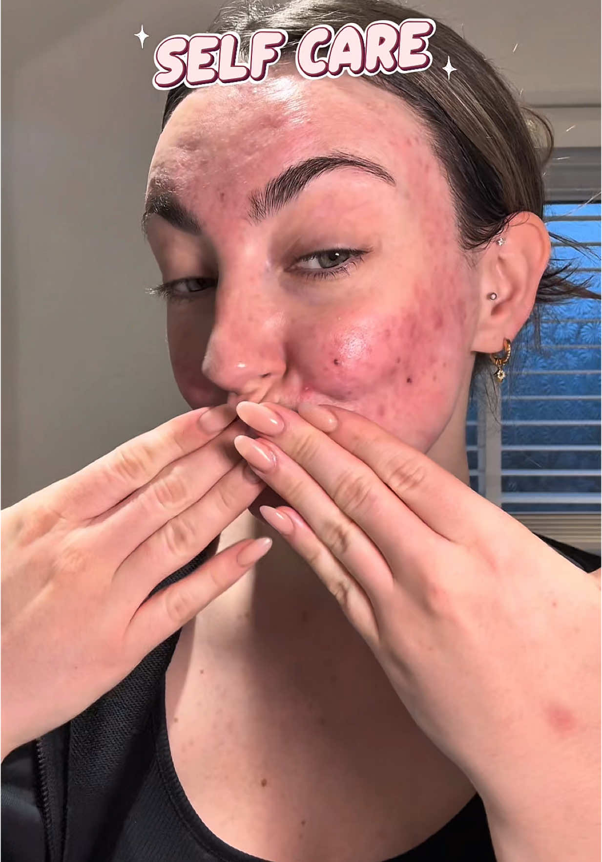 Selfcare is so important!  #acne #acneproneskin #acnepositivity #fyp #foryou #SelfCare 