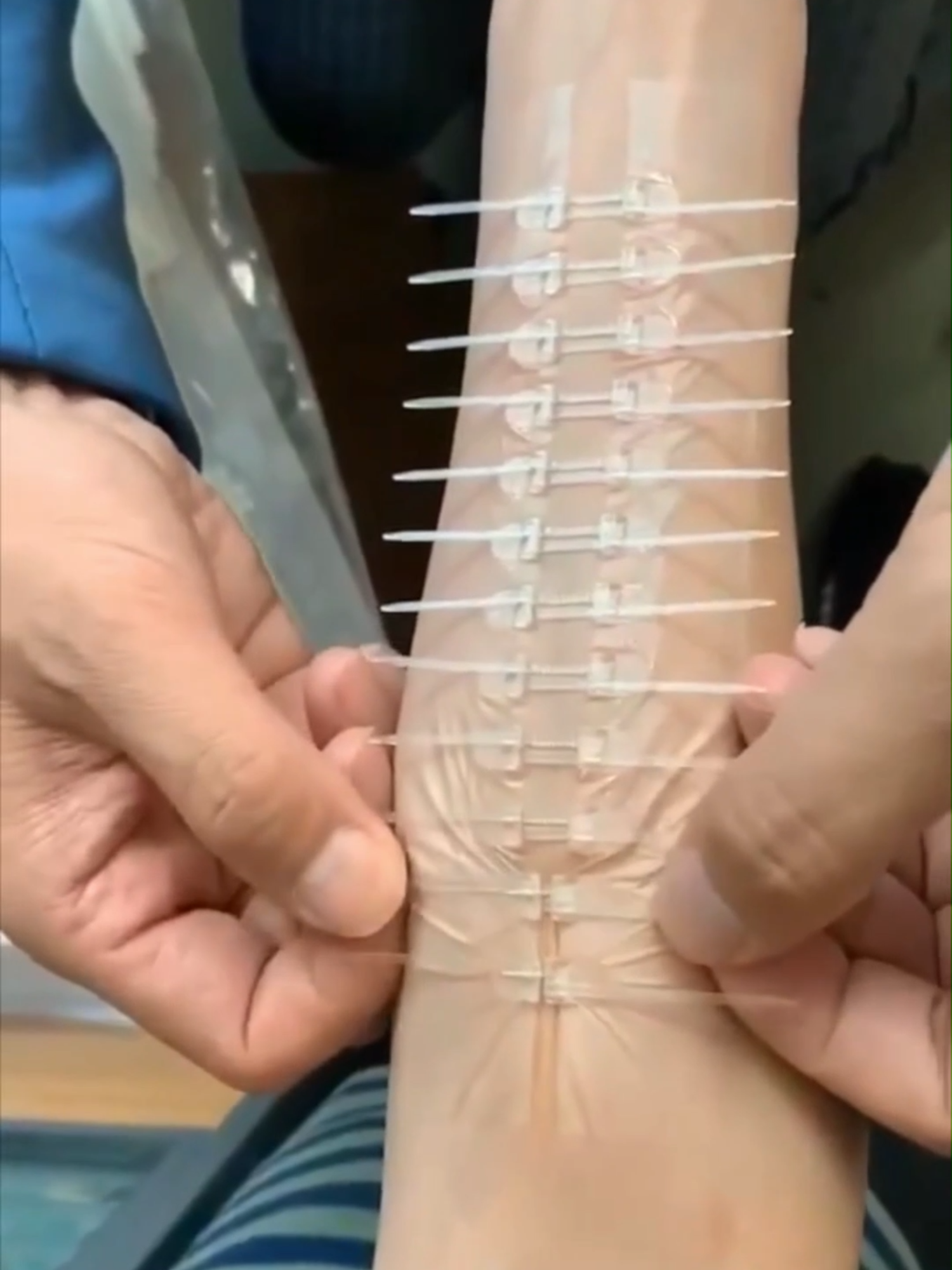 Portable Zip Stitch – Save Yourself in Emergencies! 🩹 #ZipStitch #EmergencyWoundCare #NoStitchesNeeded #FirstAidHack #MedicalInnovation #WoundClosure #PortableFirstAid #NoScarTech #DIYFirstAid #SmartHealthcare #GadgetForLife #SurvivalGear #HealthTech #LifeSavingTool #EmergencyReady #shorts #viral #trending #reelsfacebook #fyp #foryou #explorepage #FacebookReels #VideoOfTheDay #ContentCreator