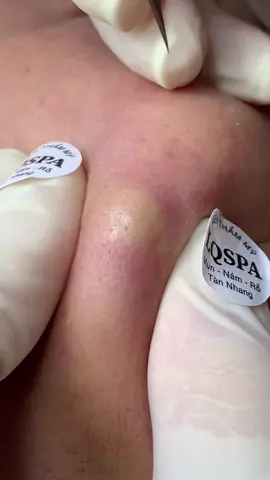 Dẻo#chamsocdaseo#chamsocda#chamsocdamun#chamsocdanam#tanbinh#govap #Lequynh#Lqspa#hocnghespa  #chamsocda #lequynhspa #vienthammylqspa #nanmunbangtay #nanmunbangtambong #nanmunbangcay